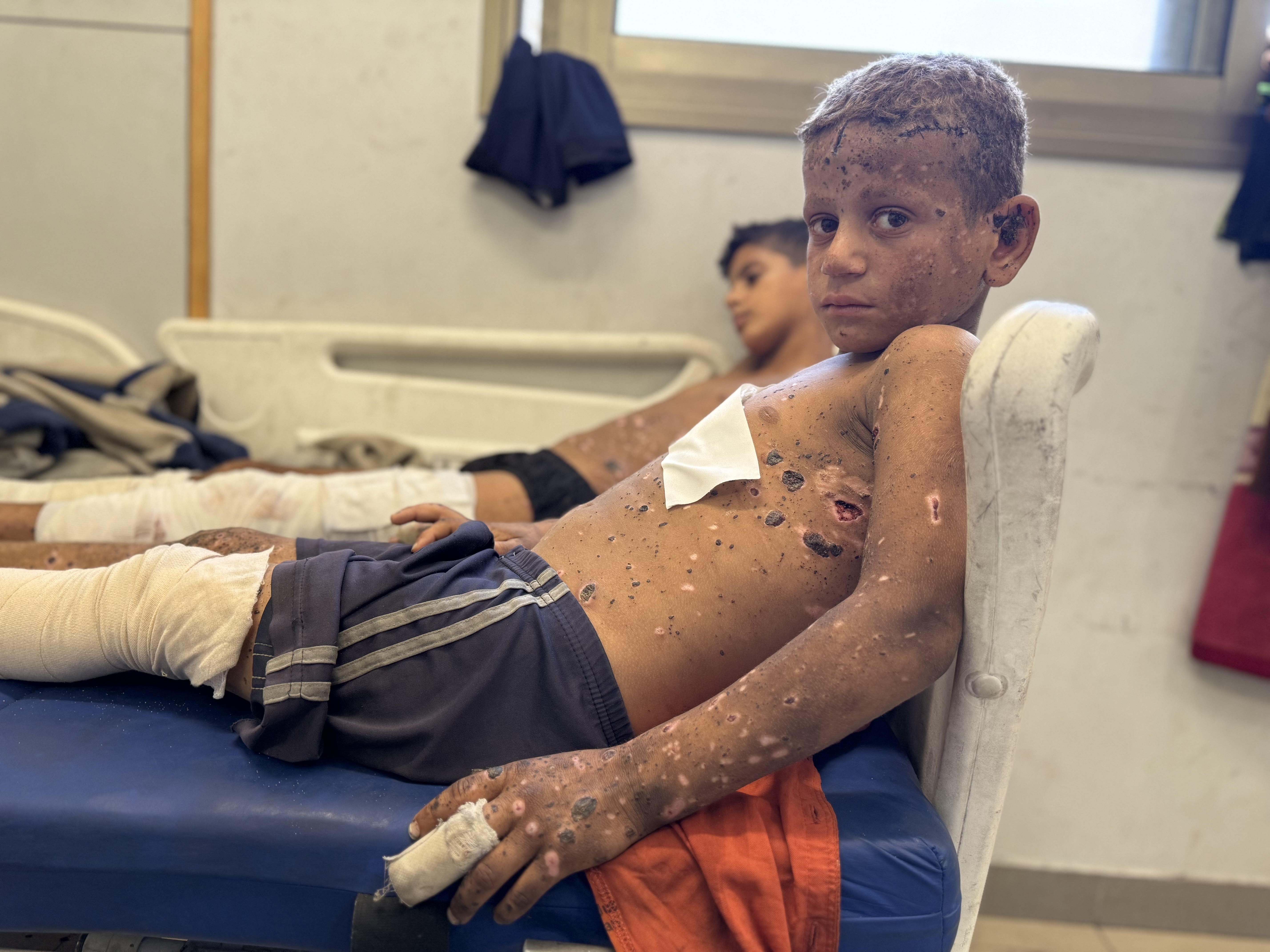 Joud Ahmad Al-Angar (right) and his 12-year-old cousin Zain Nour recuperate from injuries after they found a bucket of pellets and brought it home, thinking it could help their family. The bucket detonated.